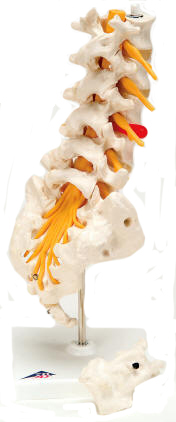 Model showing prolapsed lumbar disc