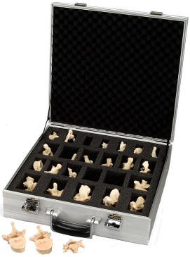Models showing osteoporosis of vertebrae