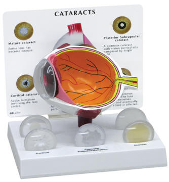Cataract Types